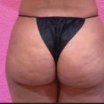 Brazilian Butt Lift Before & After Patient #341