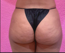 Brazilian Butt Lift Before & After Patient #341