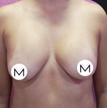 Breast Augmentation Before & After Patient #344