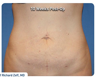 Renuvion/J-Plasma Before & After Patient #298