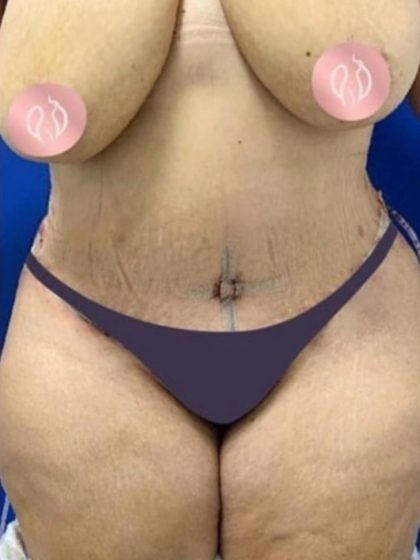 Mommy Makeover Before & After Patient #866